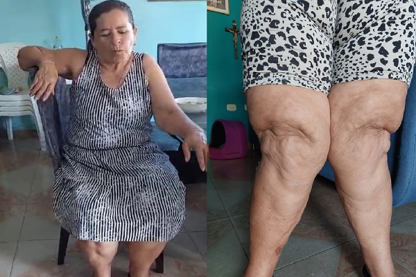 El draman de Susana. Entre la artrosis y Coosalud la tienen viviendo sus peores días