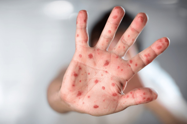 Viruela del mono no ha llegado a Valledupar, pero autoridades de salud están alerta e instan a mantener medidas de autocuidado