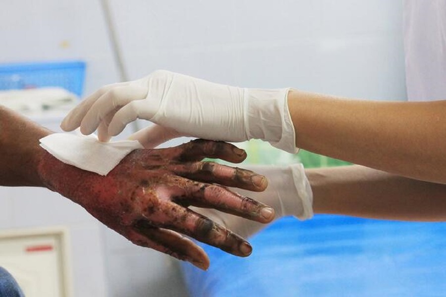 Preocupante aumento de lesionados por pólvora en el Cesar: Llamado a la responsabilidad y conciencia colectiva