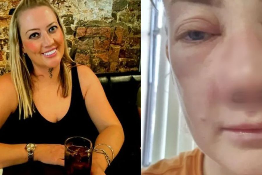 Mujer viajó para hacerse un procedimiento dental y contrajo una bacteria que le desfiguró el rostro